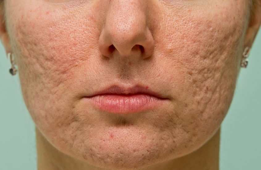 acne scar treatment methods